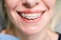 Porady dotyczące higieny jamy ustnej dla osób noszących aparaty ortodontyczne